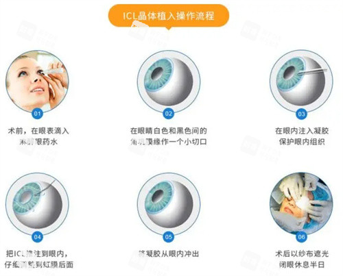 ICL晶体植入手术流程