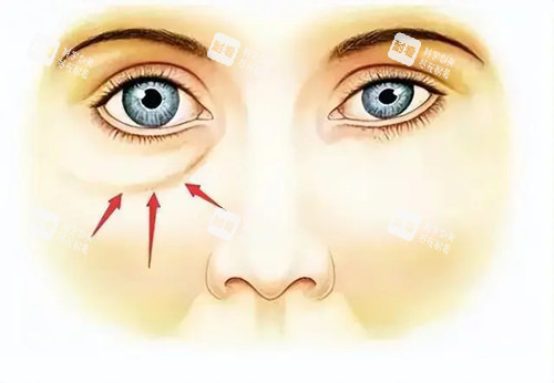 眼袋位置卡通示意图