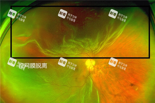 视网膜脱离照片