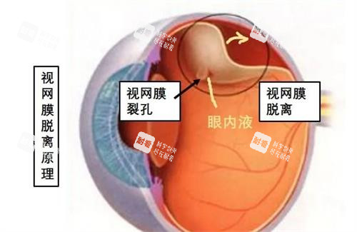 视网膜脱落原理