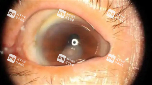 眼球有白斑 眼球有白斑