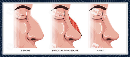 失败鼻子的前后对比图