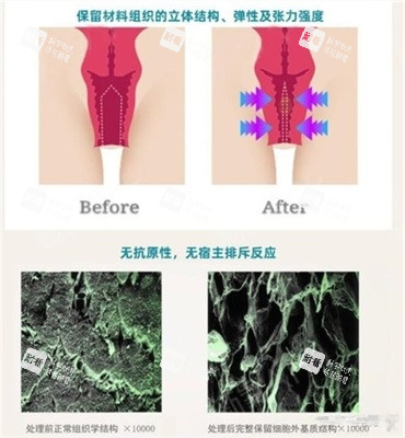 3d生物束带紧缩术前后对比漫画