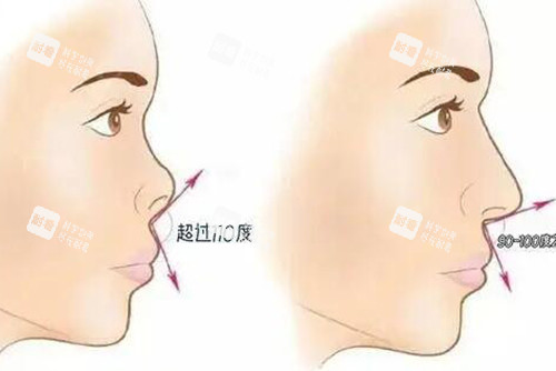 朝天鼻正常鼻子夹角对比