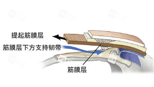 SMAS筋膜层图片展示