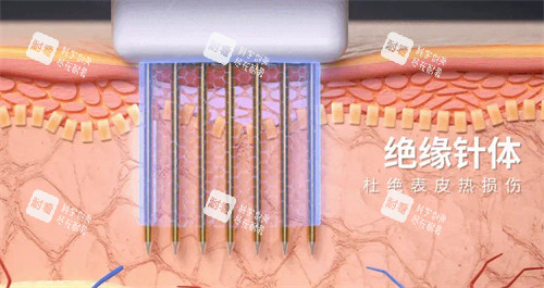 黄金微针针头图解