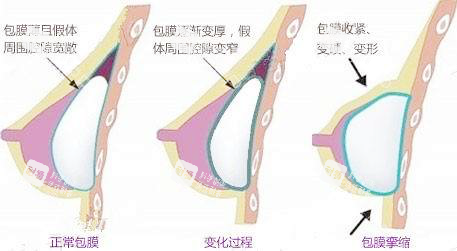 假体隆胸包膜挛缩 假体隆胸包膜挛缩