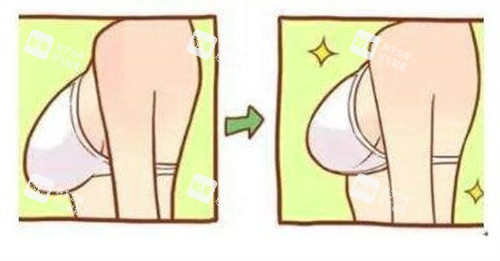 隆胸手术对比 隆胸手术对比