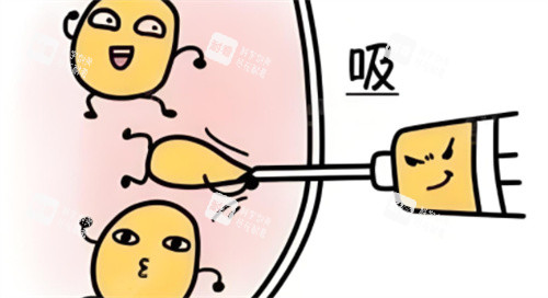 吸脂术动画 吸脂术动画