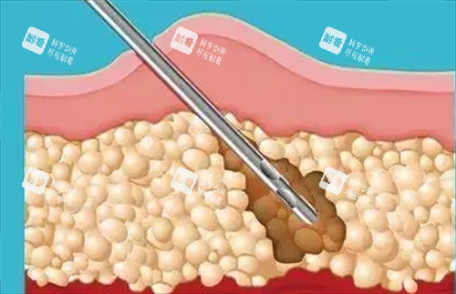 吸脂手术剖面演示图