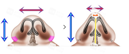 鼻翼缩小加隆鼻手术对比 鼻翼缩小加隆鼻手术对比