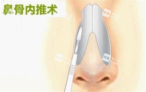 鼻骨内推手术示意图 鼻骨内推手术示意图