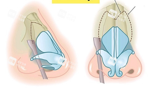鼻骨内推部位示意图 鼻骨内推部位示意图