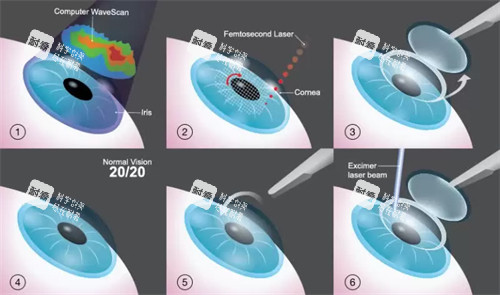 近视手术的流程图