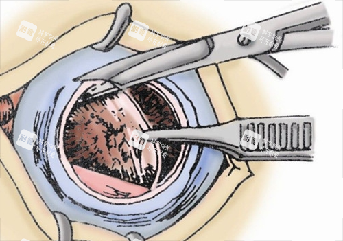 眼角膜割除动画展示 眼角膜割除动画展示