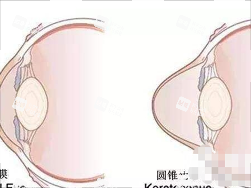 眼角膜前后对比动画展示 眼角膜前后对比动画展示