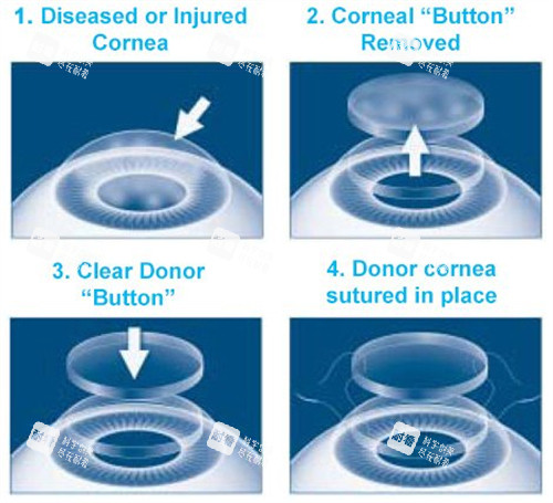 角膜移植过程图 角膜移植过程图