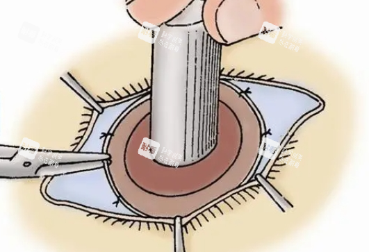 眼角膜移植手术操作展示 眼角膜移植手术操作展示