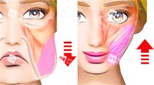 面部提升改善皮肤和脂肪下垂及位移