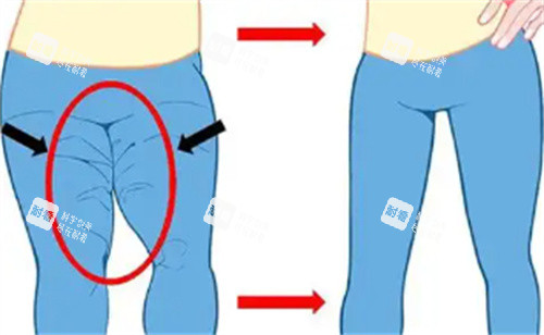 大腿吸脂对比