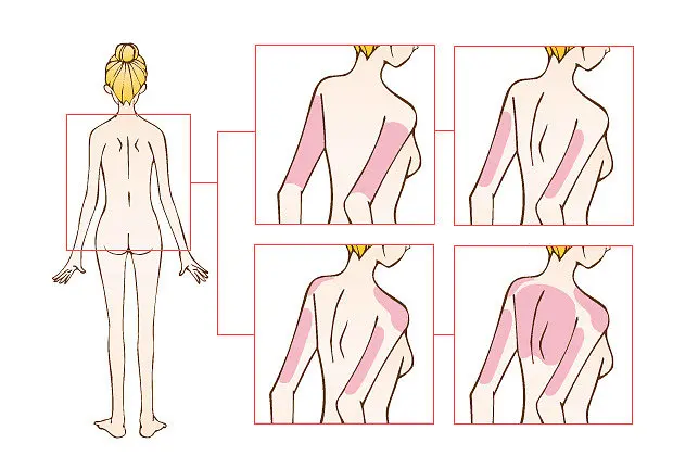 吸脂位置示意图1 吸脂位置示意图1