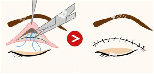 埋线双眼皮过程