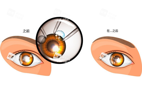 白内障手术治疗对比图
