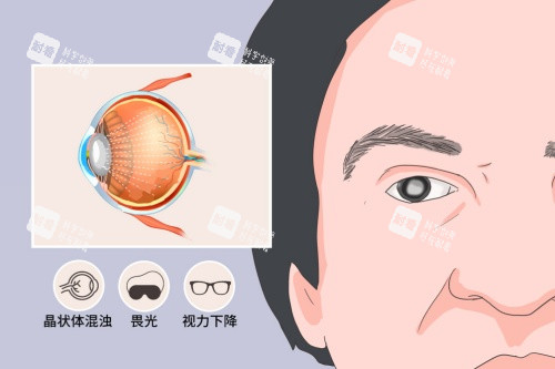 白内障症状卡通一览图