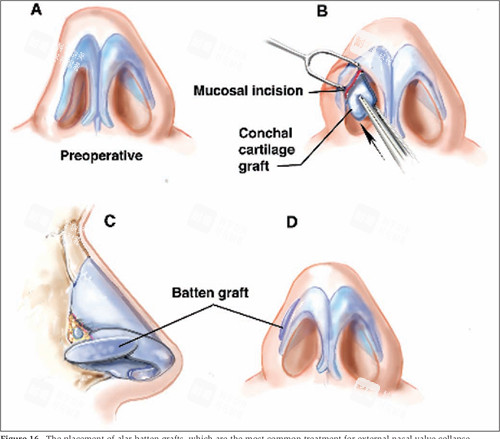 修复畸形的鼻子 修复畸形的鼻子