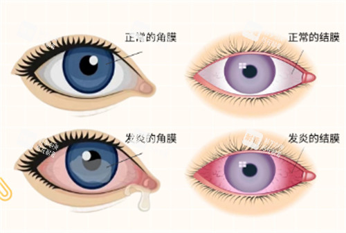 角膜炎和结膜炎分别症状