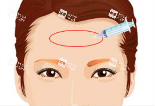 填充额头术玻尿酸注射动画图 填充额头术玻尿酸注射动画图