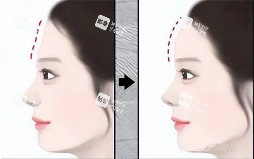 假体填充额头手术前后对比动画图 假体填充额头手术前后对比动画图