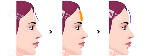 假体填充额头手术动画图 假体填充额头手术动画图