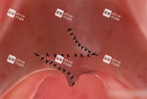 腭裂修复手术的缝合形状 腭裂修复手术的缝合形状