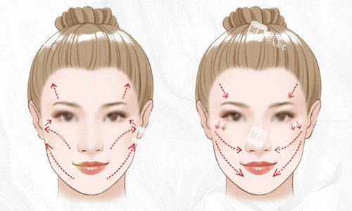 面部轮廓衰老下垂示意图 面部轮廓衰老下垂示意图