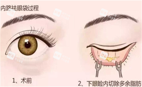 内切法祛眼袋手术 内切法祛眼袋手术