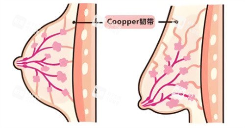 乳房下垂韧带组织对比 乳房下垂韧带组织对比