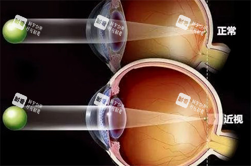 正常视力和近视视力表现图