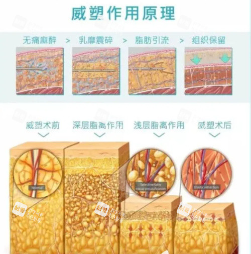 威塑二代吸脂 威塑二代吸脂