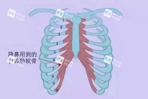 手术中一般用到的肋软骨材料