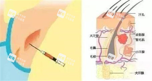 不手术去腋臭卡通图改善