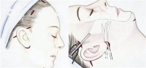 小切口拉皮手术