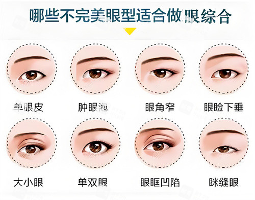 哪些眼型适合做眼综合示例动画图 哪些眼型适合做眼综合示例动画图