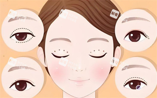 双眼皮修复手术卡通展示图 双眼皮修复手术卡通展示图