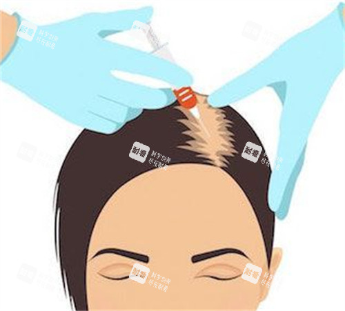 脱发PRP注射治疗过程图解