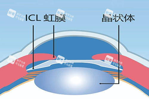 ICL晶体植入卡通图
