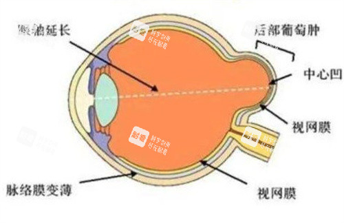 后巩膜葡萄肿 后巩膜葡萄肿