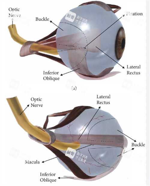 后巩膜加固术动画演示 后巩膜加固术动画演示