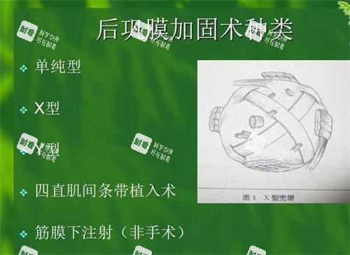 后巩膜加固术种类 后巩膜加固术种类