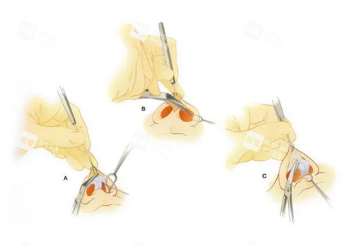 隆鼻整形切口示意图 隆鼻整形切口示意图